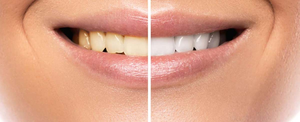 Are-you-ready-for-professional-teeth-whitening-Brighter-Whiter-Healthier-Smile