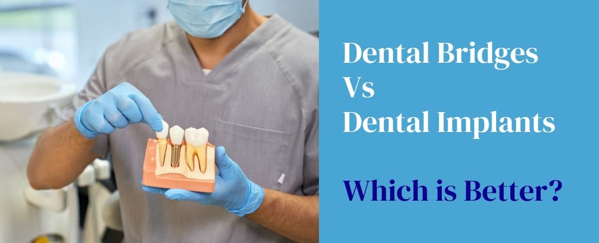 Dental Bridges Vs Dental Implants
