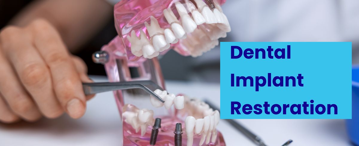 Dental-Implant-Restoration-AK-Dental-Clinic
