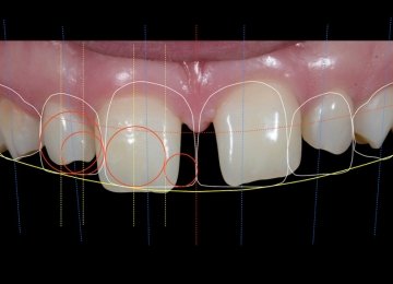 Digital-Smile-Design treatment-in-mumbai