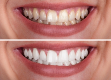 teeth-whitening-in-mumbai