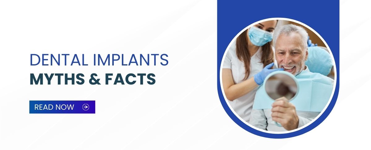 Dental-Implants-Myths- and-Facts
