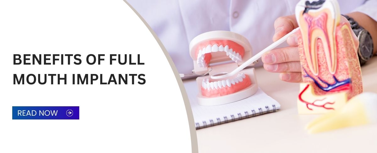 Benefits-of-Full- Mouth-Implants