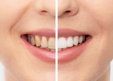 Teeth-Whitening-in- Mumbai