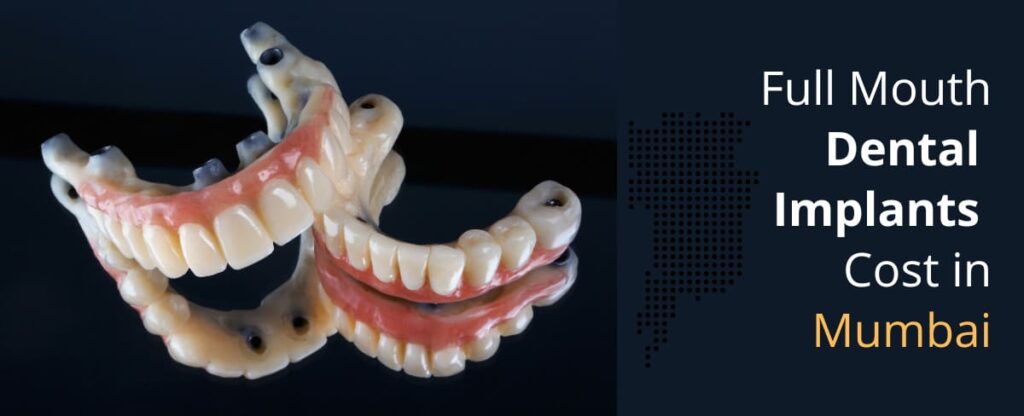 Full Mouth Dental Implants Cost in Mumbai - AK Dental Clinic