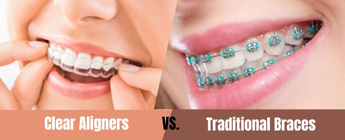 AK Dental Clear Aligners vs Traditional Braces