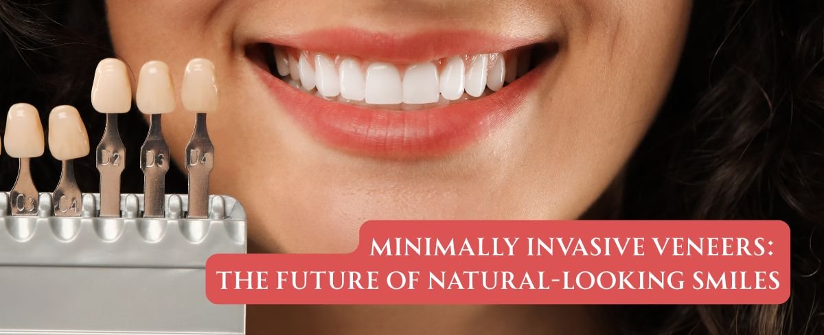 Minimally Invasive Veneers