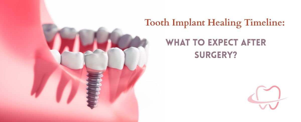 Tooth Implant Healing Timeline