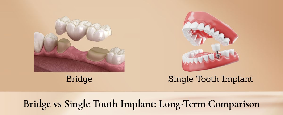 Bridge vs Single Tooth Implant Long-Term Comparison