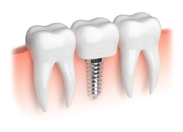 Dental-Implants-in- Mumbai