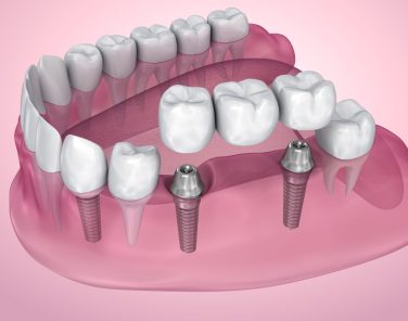 Multiple-Teeth- Implants-AK-Dental-Clinic