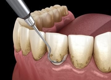 Scaling and Polishing