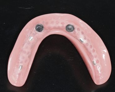 dentures -AK-Dental-Clinic