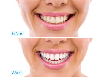 teeth-whitening-treatments-in-mumbai
