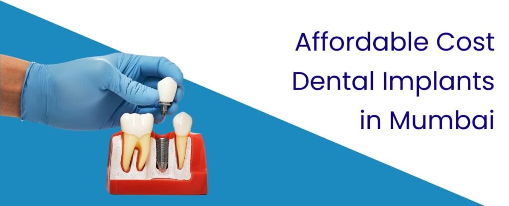Affordable Cost Dental Implants in Mumbai