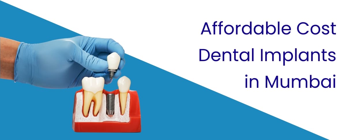 Affordable Cost Dental Implants in Mumbai