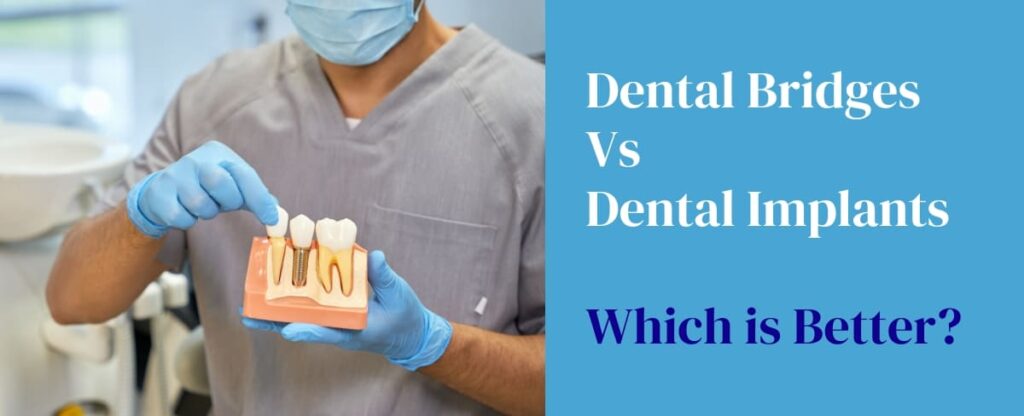 Dental Bridges Vs Dental Implants