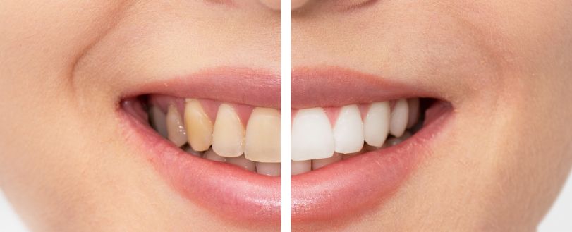best-teeth-whitening-in-Mumbai