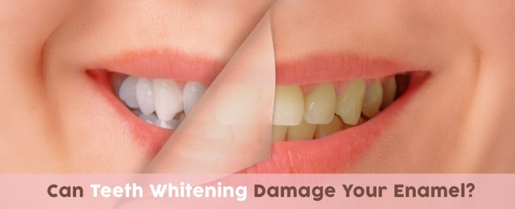Can teeth whitening damage your enamel