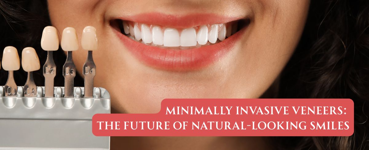 Minimally Invasive Veneers